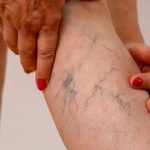 crema pentru varice