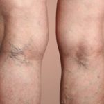 leacuri batranesti pentru varice